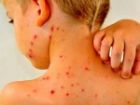 بدترین شیوع سرخک 35 سال گذشته در آمریکا