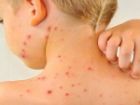 وضعیت دو بیماری ویروسی مسری در کشور+جدول